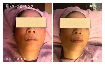 ハーブピーリングのモニター様のお写真
