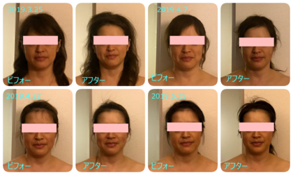 小顔モニター様４回目終了。
