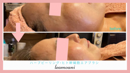 ハーブピーリング+ヒト幹細胞エアブラシ仕上げ、お顔のむくみも取れてすっきり！
