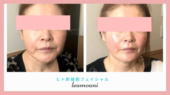 ハリツヤ、フェイスラインすっきり！