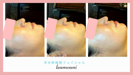 肌再生で根本ケア