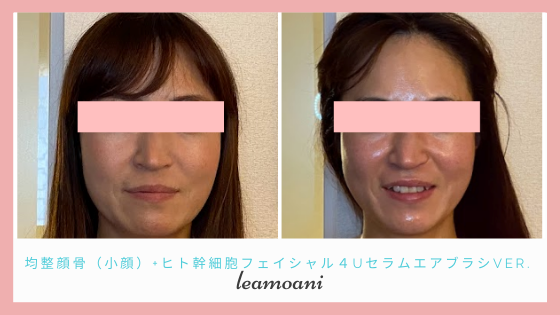 オプション均整顔骨でさらにしっかり小顔に
