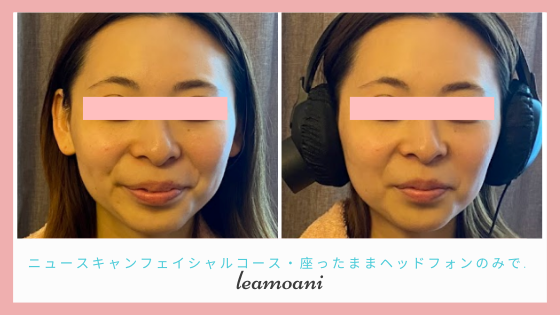 バージョンアップしたニュースキャンSWⅢ®によるフェイシャルコースはわずか数分でこのリフトアップ！