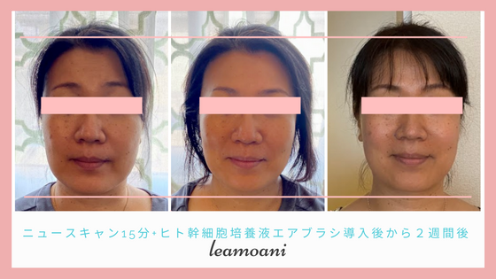 20分小顔から２週間後